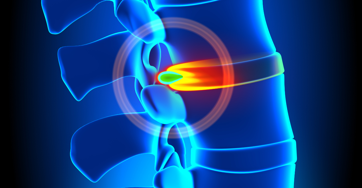 Hérnia de Disco